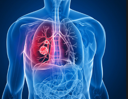 Causes of Mesothelioma