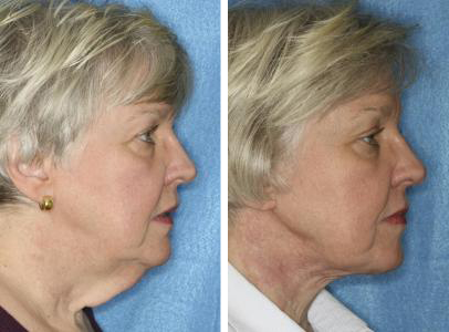 Neck Lift Surgeries